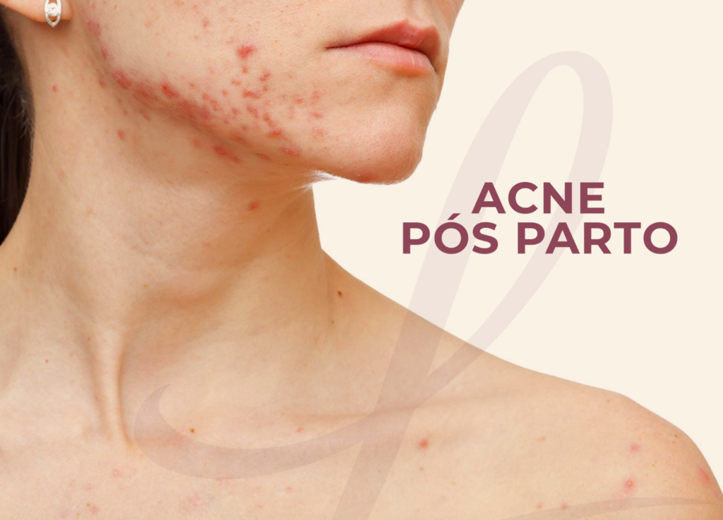 Acne Pós Parto