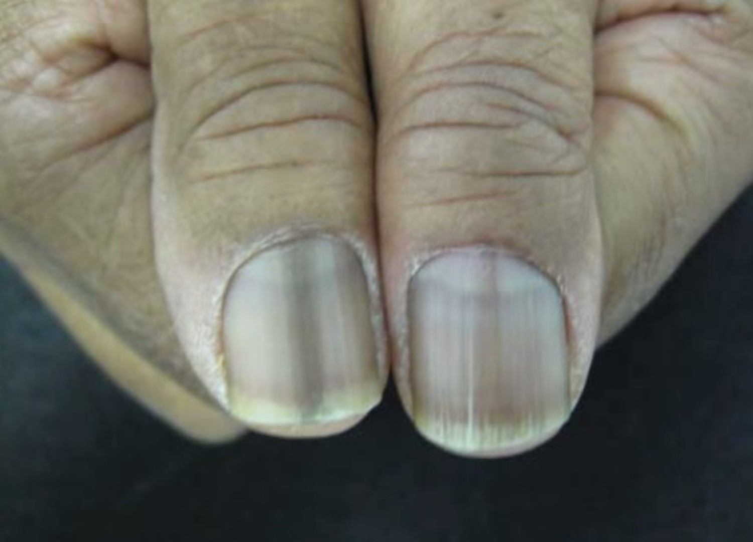 Linha escura na unha: preciso me preocupar? – Dra. Lívia